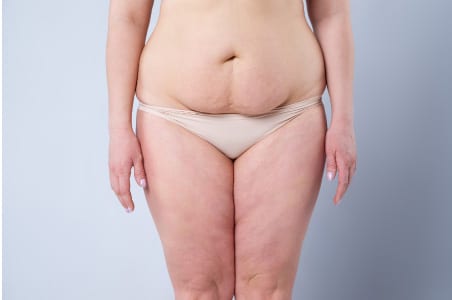 Tummy Tuck To Lose Weight