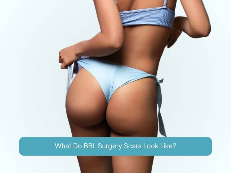 What Do BBL Surgery Scars Look Like
