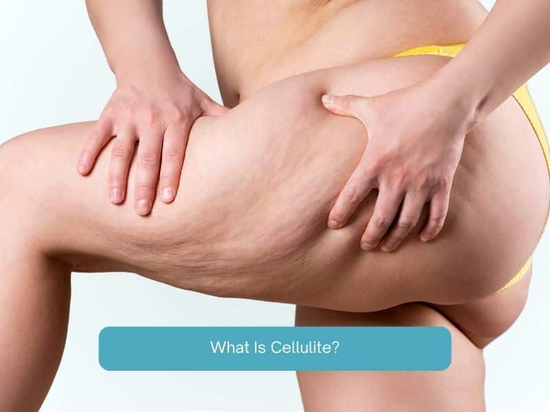 What is Cellulite