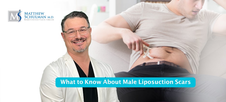 What To Know About Male Liposuction Scars