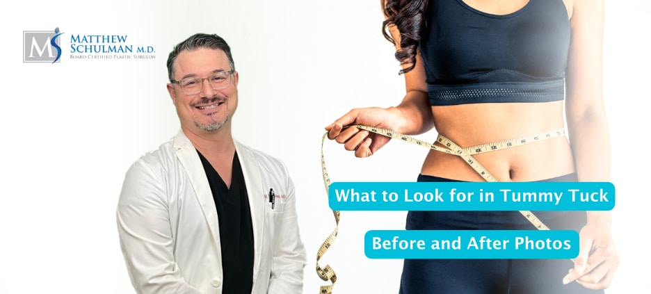 What To Look For In Tummy Tuck Before And After Photos