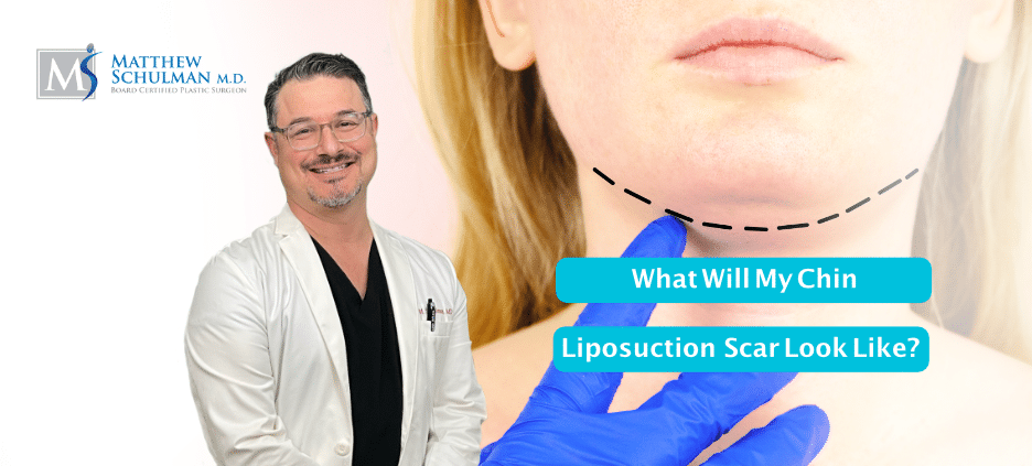 What Will My Chin Liposuction Scar Look Like