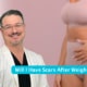 Will I Have Scars After Weight Loss Surgery