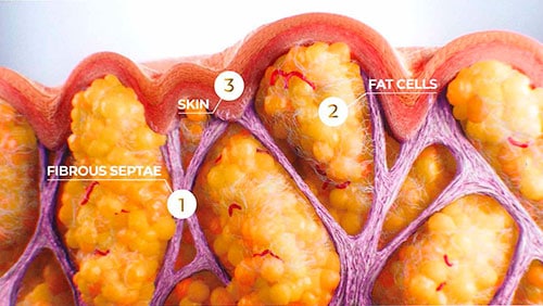 QWO Cellulite Reduction