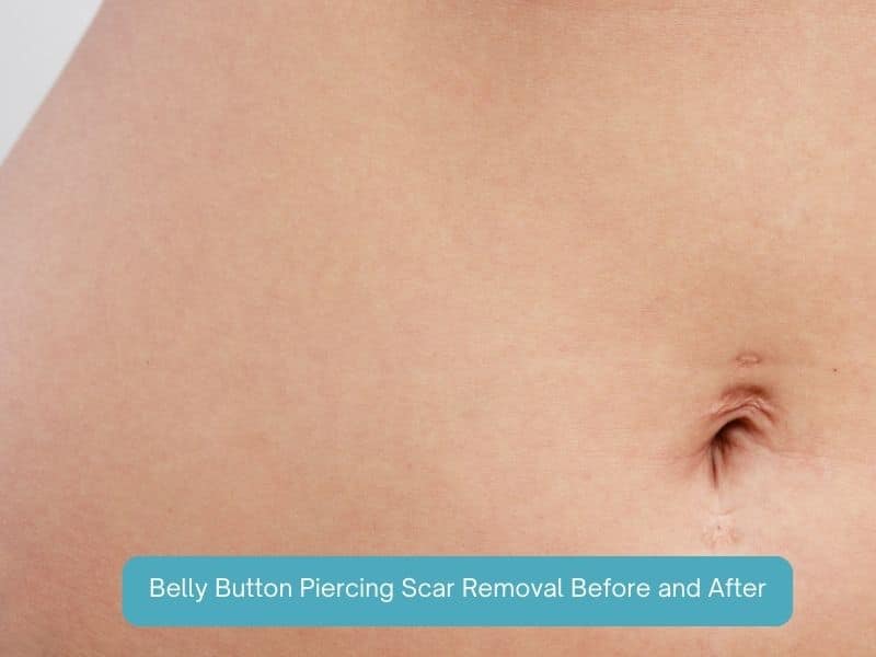 belly button piercing scar removal before and after