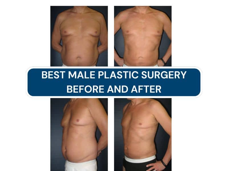 best male plastic surgery before and after