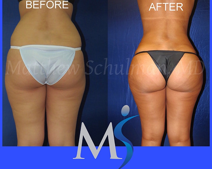 Brazilian Butt Lift Cost Philadelphia