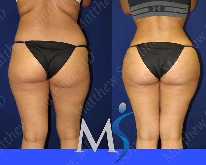 Brazilian Butt Lift Recovery Philadelphia