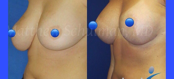 breast lift NYC patient 4