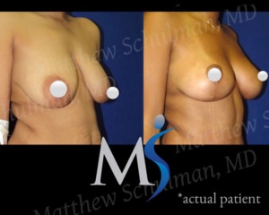 Breast Lift New York City