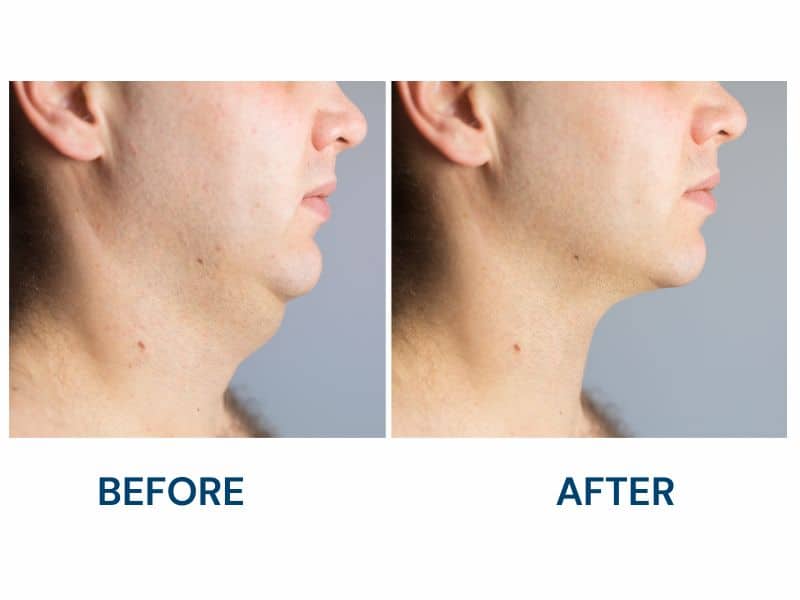 chin lipo before and after men