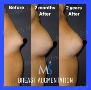  New York City Breast Augmentation 