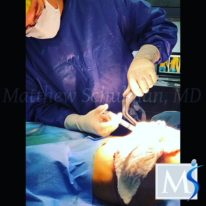 New York City Botox-Assisted Breast Augmentation