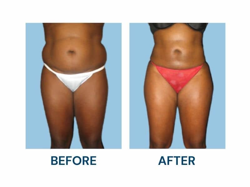 love handle liposuction before and after