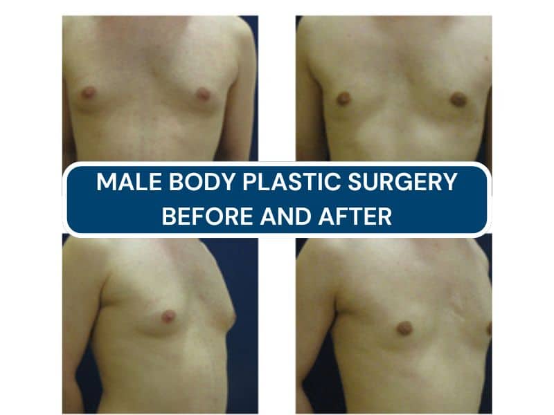 male body plastic surgery before and after