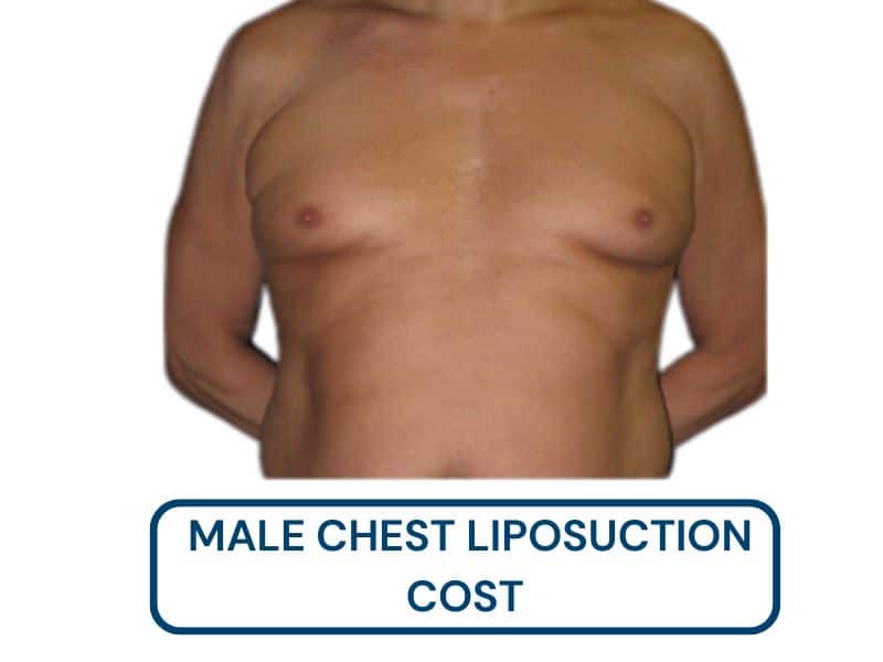 male chest liposuction cost