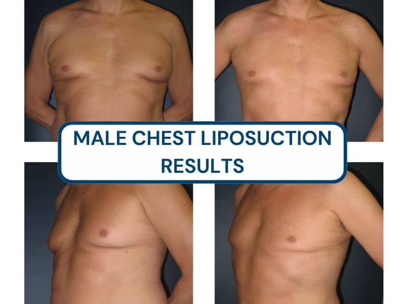 male chest liposuction results