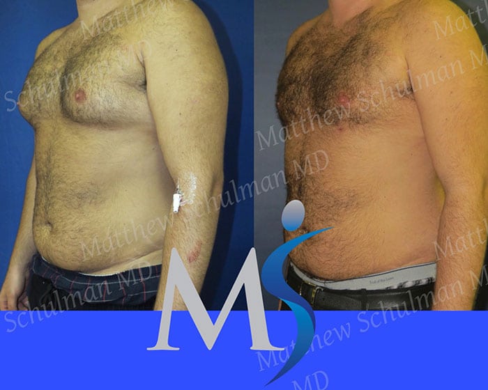 Flanks liposuction NYC - Best Flanks liposuction in NYC