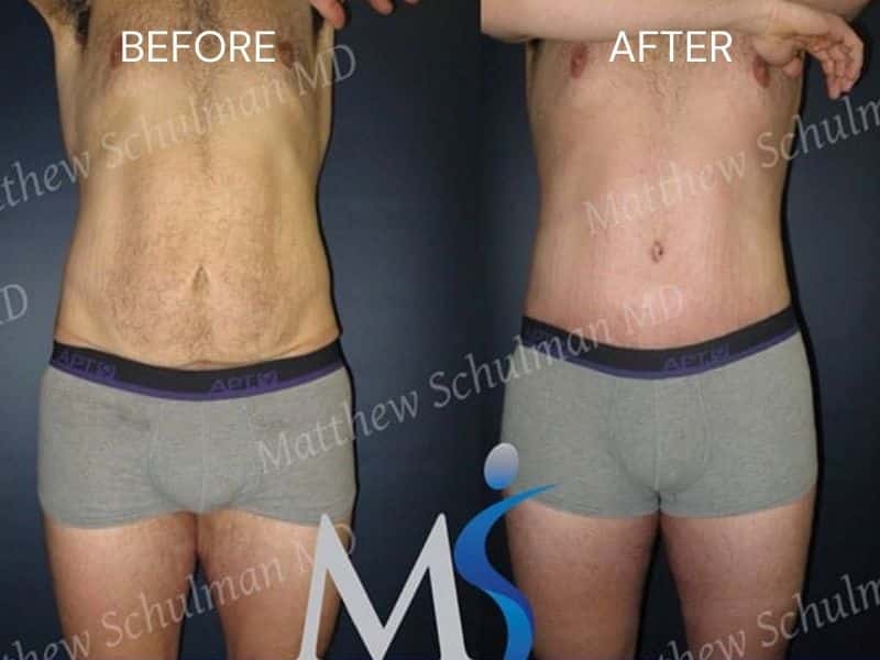 male mini tummy tuck before and after