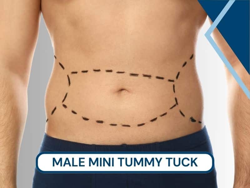 male mini tummy tuck