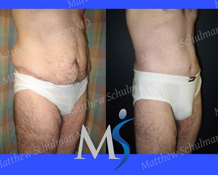 Tummy Tuck Surgery NYC New York