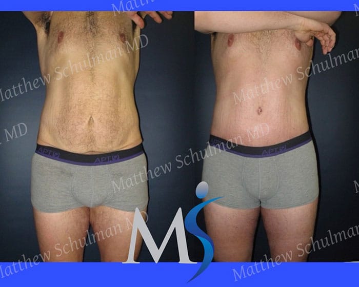 Tummy Tuck Surgery NYC New York