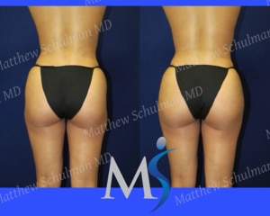 https://www.drschulmanplasticsurgery.com/wp-content/uploads/non-surgicL-BBL-patient-1-300x240.jpg