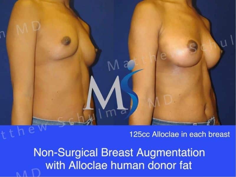non surgical breast augmentation with