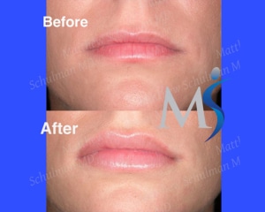 Lip Implants NYC