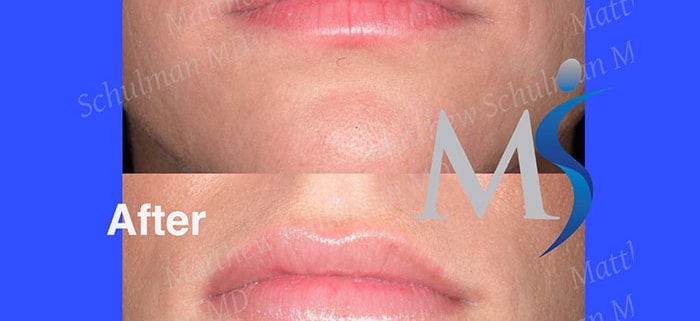 Lip Implants NYC