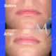 Lip Implants NYC