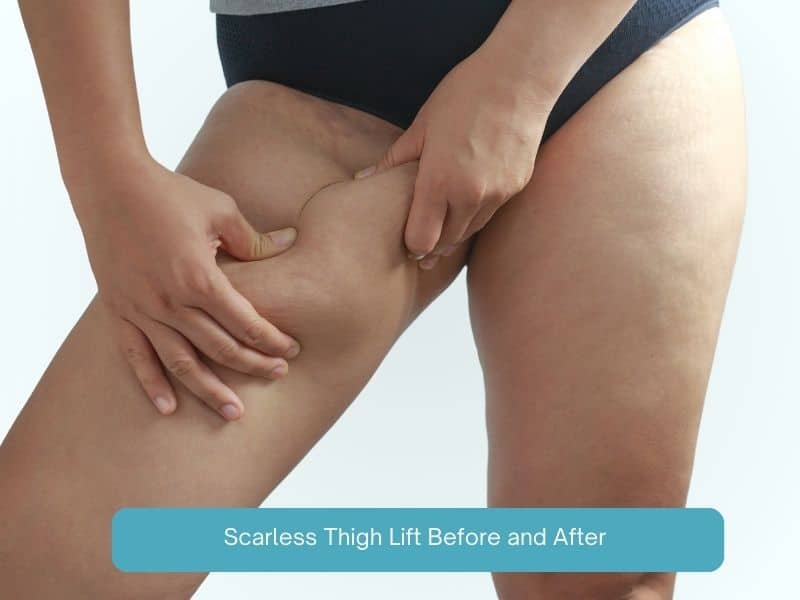 scarless thigh lift before and after