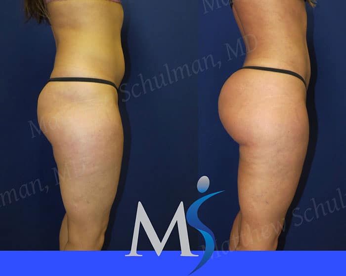 SCOOP Lift ® Buttock Lift Contouring New York City