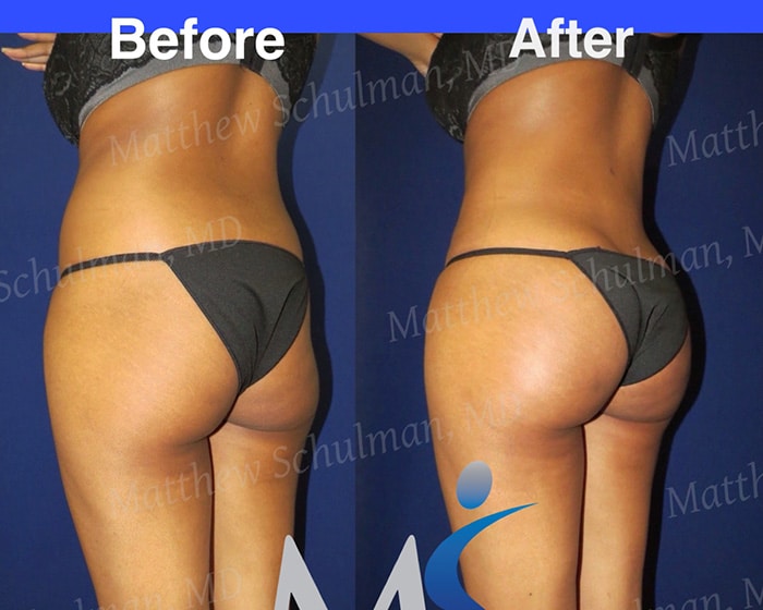 Scranton Brazilian Butt Lift