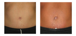 Belly Button Surgery New York City
