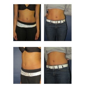 Belly Button Surgery Photos Matthew Schulman M.D
