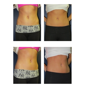 Belly Button Surgery New York City Patient 12