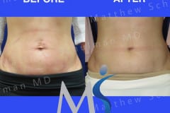 NYC BellyButton Surgery