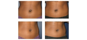 New York City Belly Button Surgery