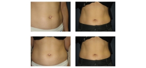 Belly Button Surgery Ne w York City