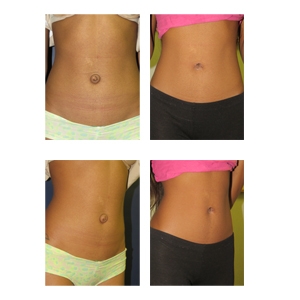 Umbilicoplasty-New-York-City-Patient-10-Thumbnail