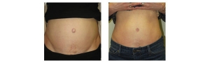 Belly Button Surgery