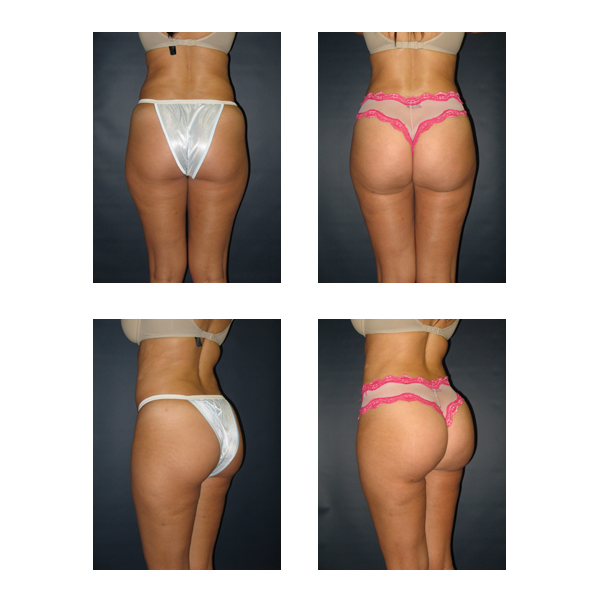 Laser Liposuction BBL Before and After