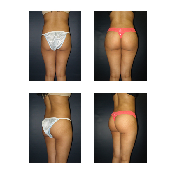 Brazilian Butt Lift (BBL) Before & After Photos Patient 109