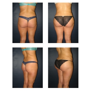 Brazilian-Butt-Augmentation-NYC