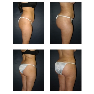 Brazilian-Butt-LIft