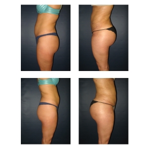Brazilian-Butt-Lift