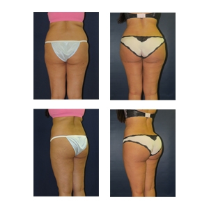 Brazilian-Butt-Lift-NYC