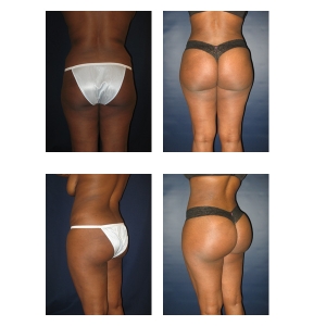 Brazilian-Butt-Lift-NYC