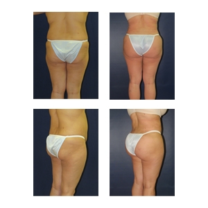 Brazilian-Butt-Lift-New-York-City